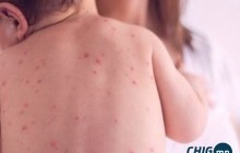 Улаанбурхан өвчний улмаас 10 хүн нас бараад байна