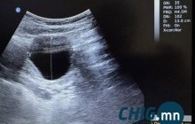 Сэрэмжлүүлэг: 15 настай охин 5 см уйланхайтай, ээж хүү хоёр элэгний ижил өөхлөлттэй байна 