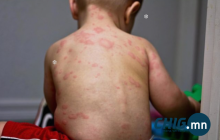 Увс аймагт менингитийн халдвар бүртгэгдлээ