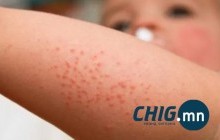 Сэрэмжлүүлэг: Менингококкийн 7 тохиолдол, 3 нас баралт бүртгэлээ 