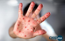 ХӨСҮТ: Өдөрт дунджаар улаанбурхан өвчний 14 тохиолдол бүртгэгдэж байна