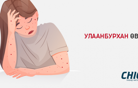 Улаанбурхан өвчний халдвар тархаж, хоногт 19 шинэ тохиолдол бүртгэгдлээ