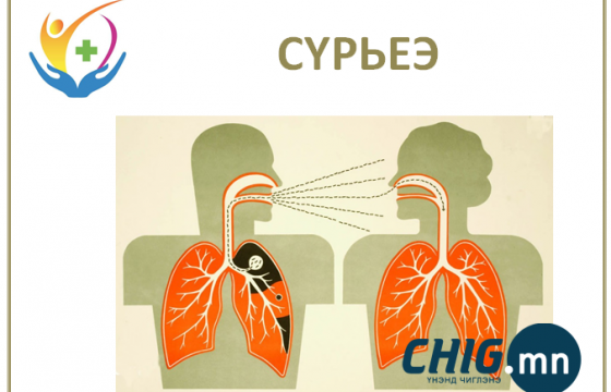 Сүрьеэгийн өвчлөлийн 6-7 хувийг хүүхдүүд эзэлж байна