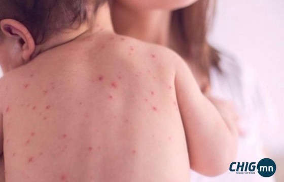 Улаанбурхан өвчний лабораториор батлагдсан тохиолдол 414 болжээ
