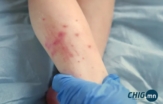 143 дугаар сургуулийн 6 хүүхдэд улаанбурхны шинж тэмдэг илэрч, халдвар дэгджээ