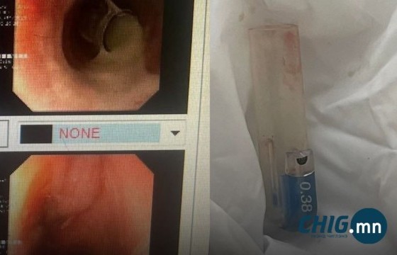 Сэрэмжлүүлэг: 11 настай хүүхэд балны таг залгиад хагалгаанд оржээ 