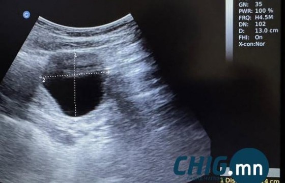 Сэрэмжлүүлэг: 15 настай охин 5 см уйланхайтай, ээж хүү хоёр элэгний ижил өөхлөлттэй байна 