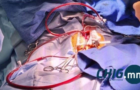 УГТЭ гадагшаа урсах ₮17,7 тэрбумыг хэмнэж, 500 зүрхний хагалгааг хийлээ  