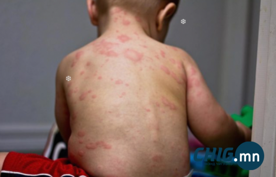 Дорнод аймагт улаанбурхан өвчний 118 тохиолдол бүртгэгдээд байна