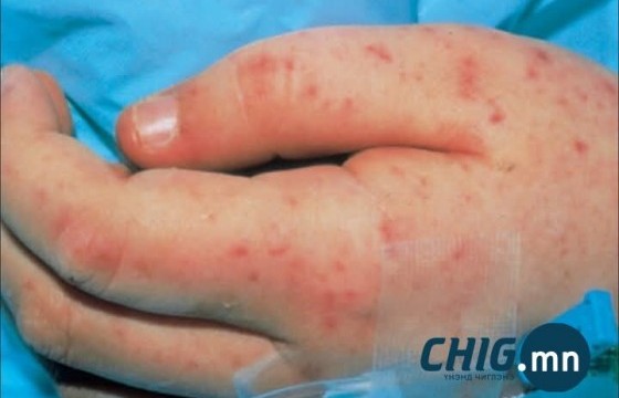 ХӨСҮТ: Менингитийн эрсдэл өндөр улирал эхэллээ 