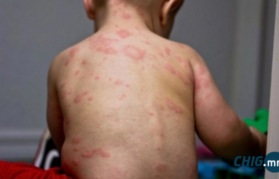 Дархан-Уул, Ховд аймагт менингококкт халдварын  тохиолдол бүртгэгджээ