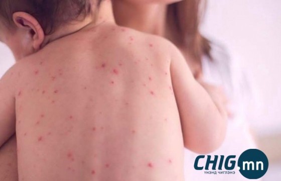 Улаан бурхан өвчний тохиолдол улсын хэмжээнд 14'365 бүртгэгдэж нас баралтын тоо 15 хүрлээ