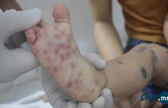 Вьетнамд гар, хөл, амны өвчин дэгдэж, гурван хүн нас барлаа