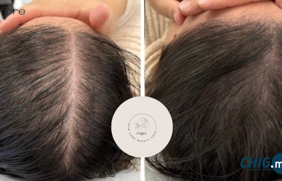 Үс уналт нэмэгдэж буй энэ үед “Gegee Skin Care Beauty” салон PRP эмчилгээ хийж байна 